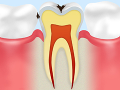 C1：初期虫歯（う蝕症第1度）