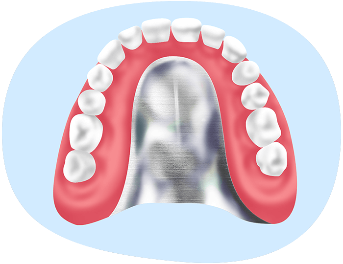 コバルトクロム義歯