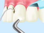 1.歯間の汚れ除去