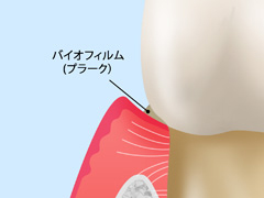 その1　歯肉炎