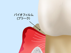 その2　軽度歯周炎