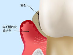 その3　中程度歯周炎