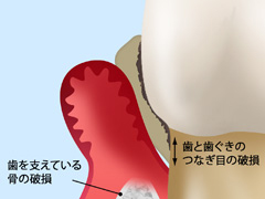 その4　重度歯周炎